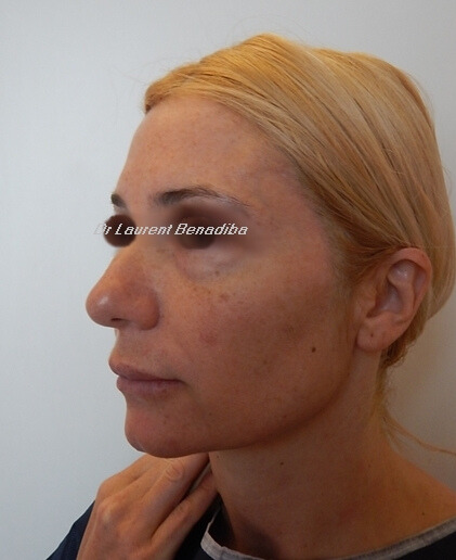 Lifting cervico-facial cleage avant