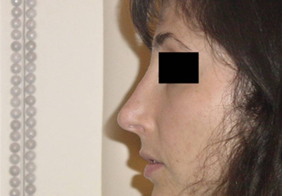 Rhinoplastie chirurgicale Genève après