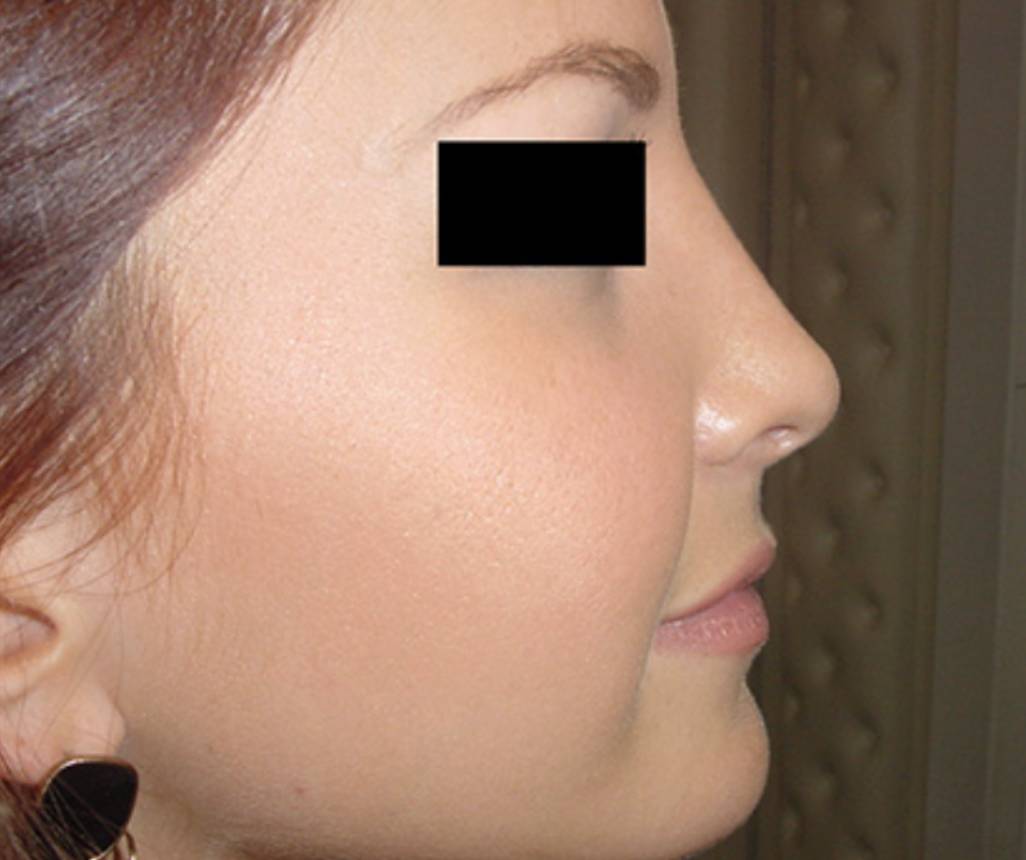 Rhinoplastie nez Genève après