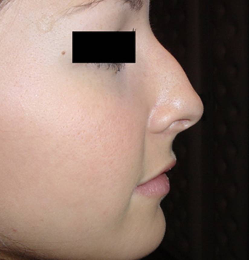 Rhinoplastie nez Genève avant