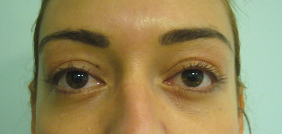 Blépharoplastie Chrirugicale cleage avant