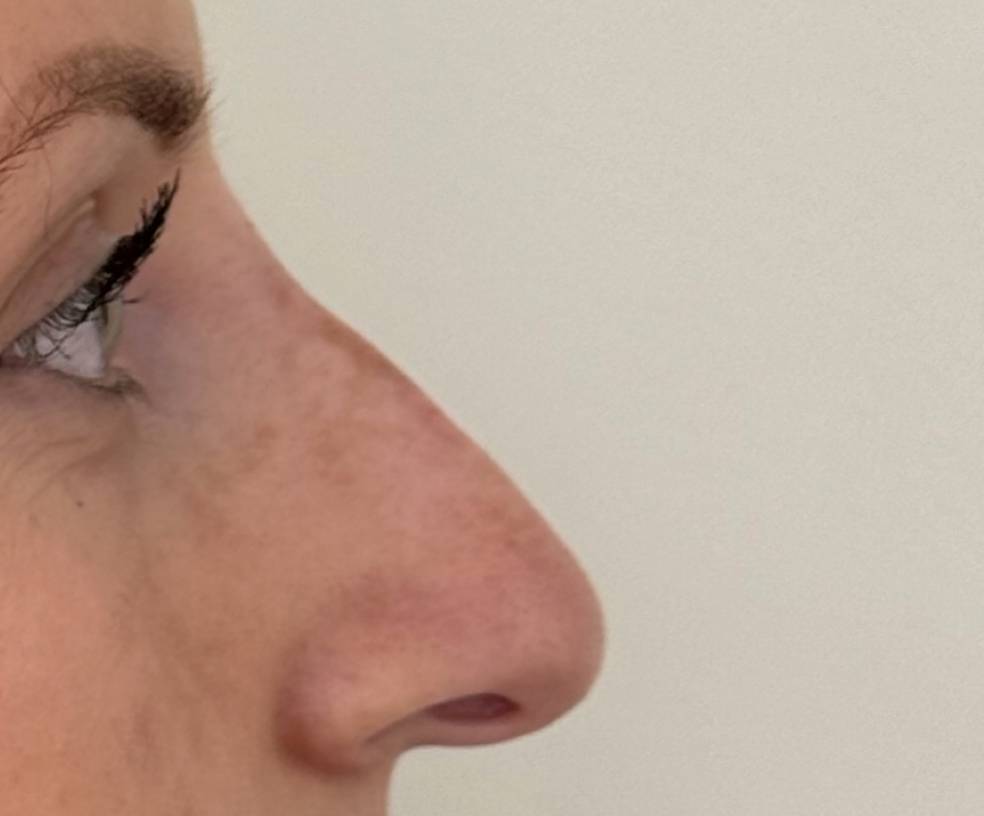 Rhinoplastie chirurgicale après