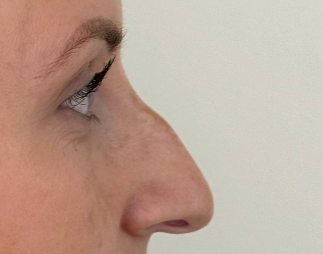 Rhinoplastie chirurgicale avant