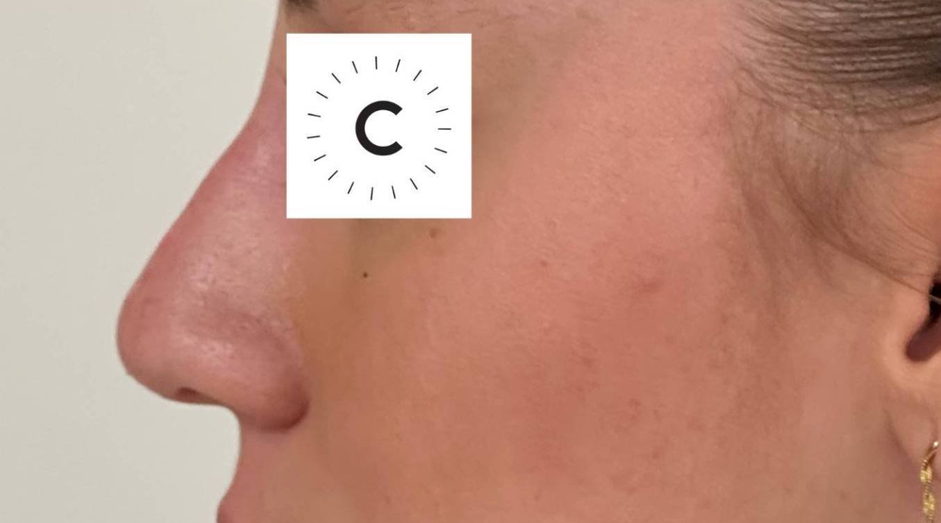 Rhinoplastie médicale après Dr Cohen Cleage Clinic