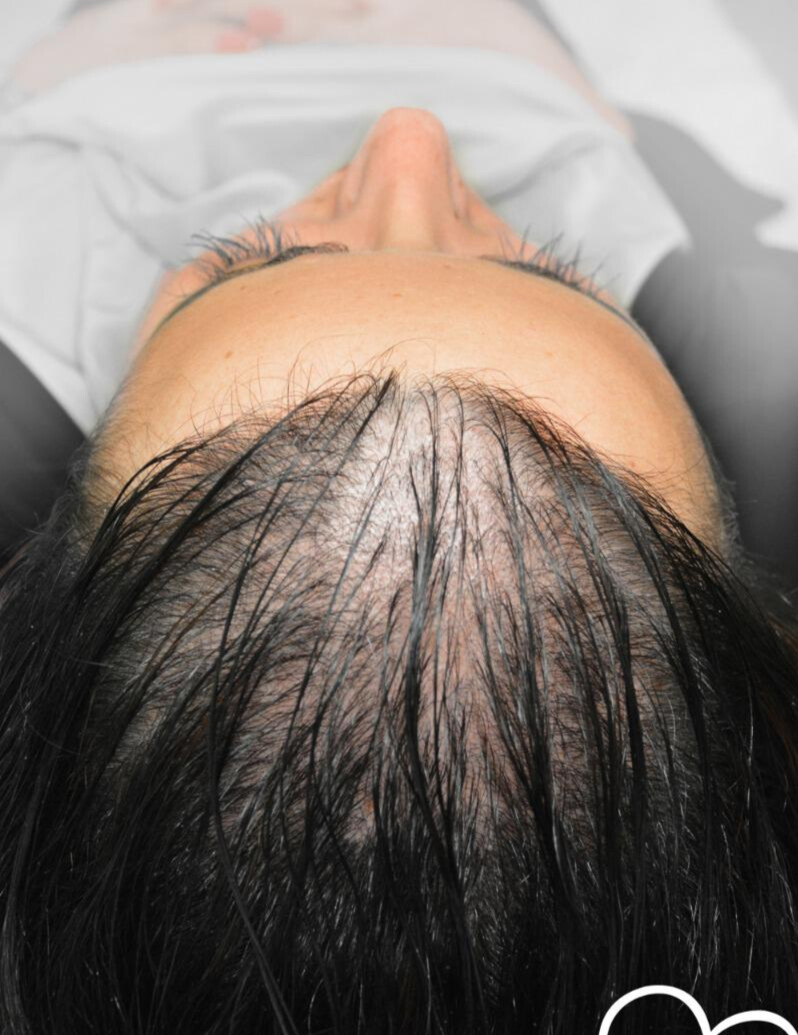 Tricopigmentation femme Avant Clinique Cleage Genève