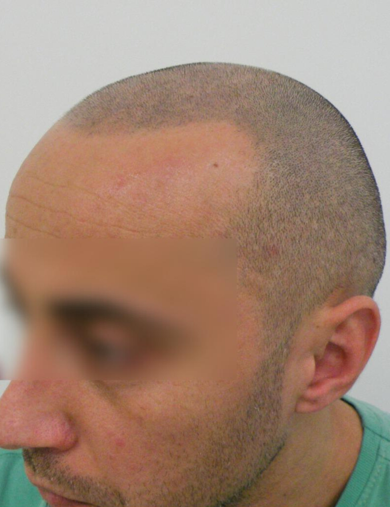 Tricopigmentation après Cleage