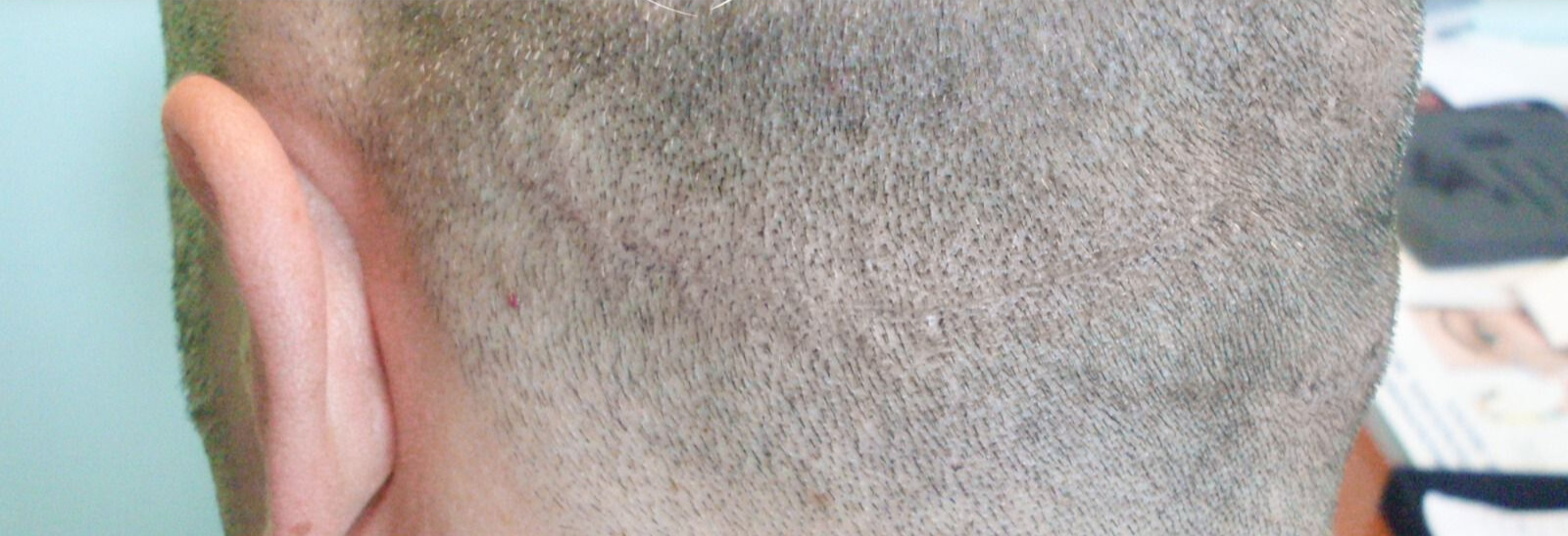 Tricopigmentation Cleage