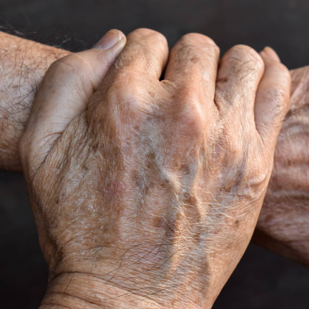 Traitement Cleage des tache pigmentaire sur les mains