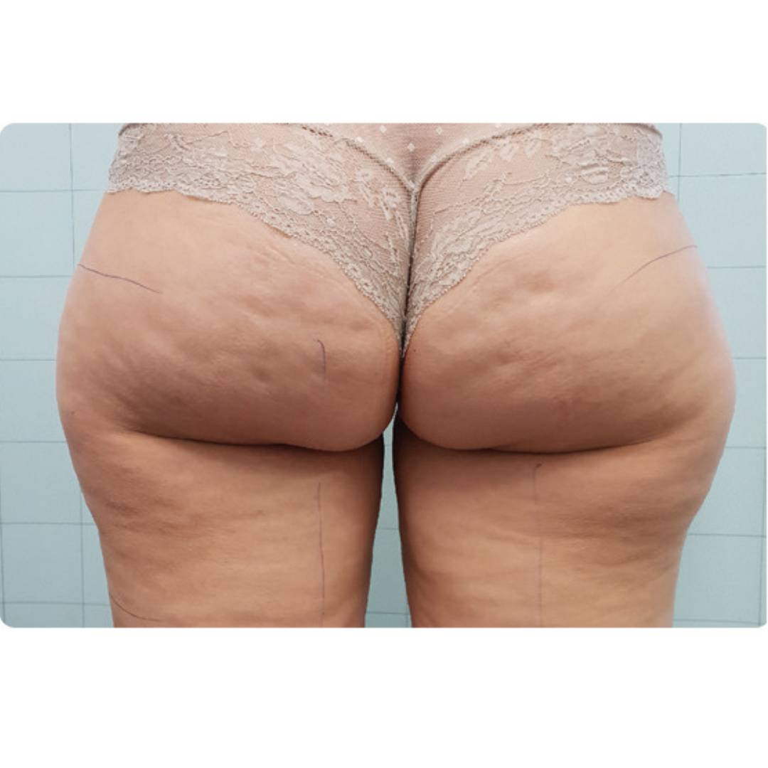 Traitement de la cellulite par onde coolwaves clinique Cleage