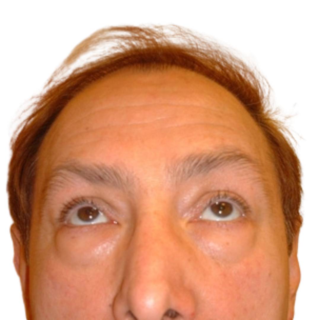 Blépharoplastie inférieure homme avant CLEAGE