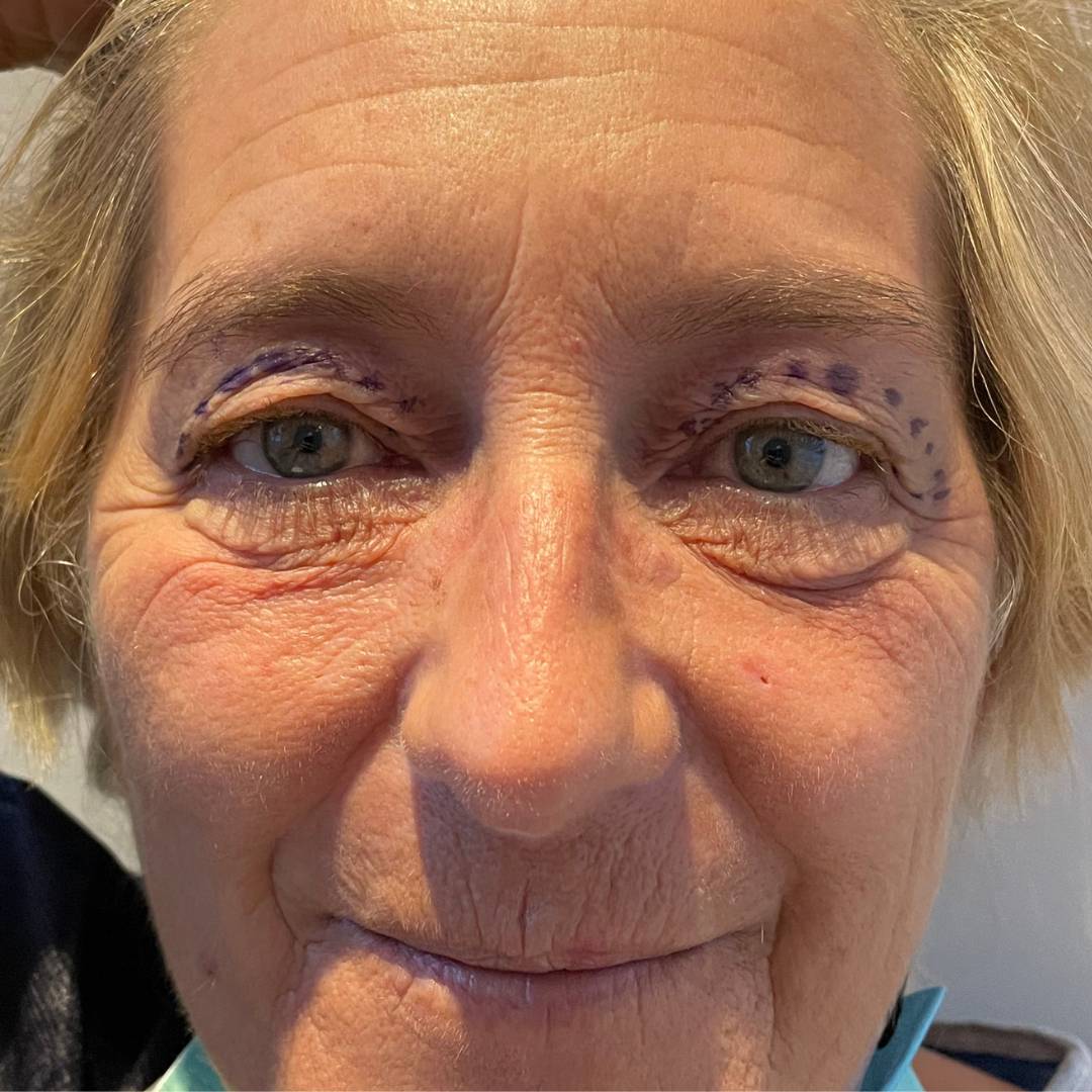 Blépharoplastie supérieure Chirurgie Cleage