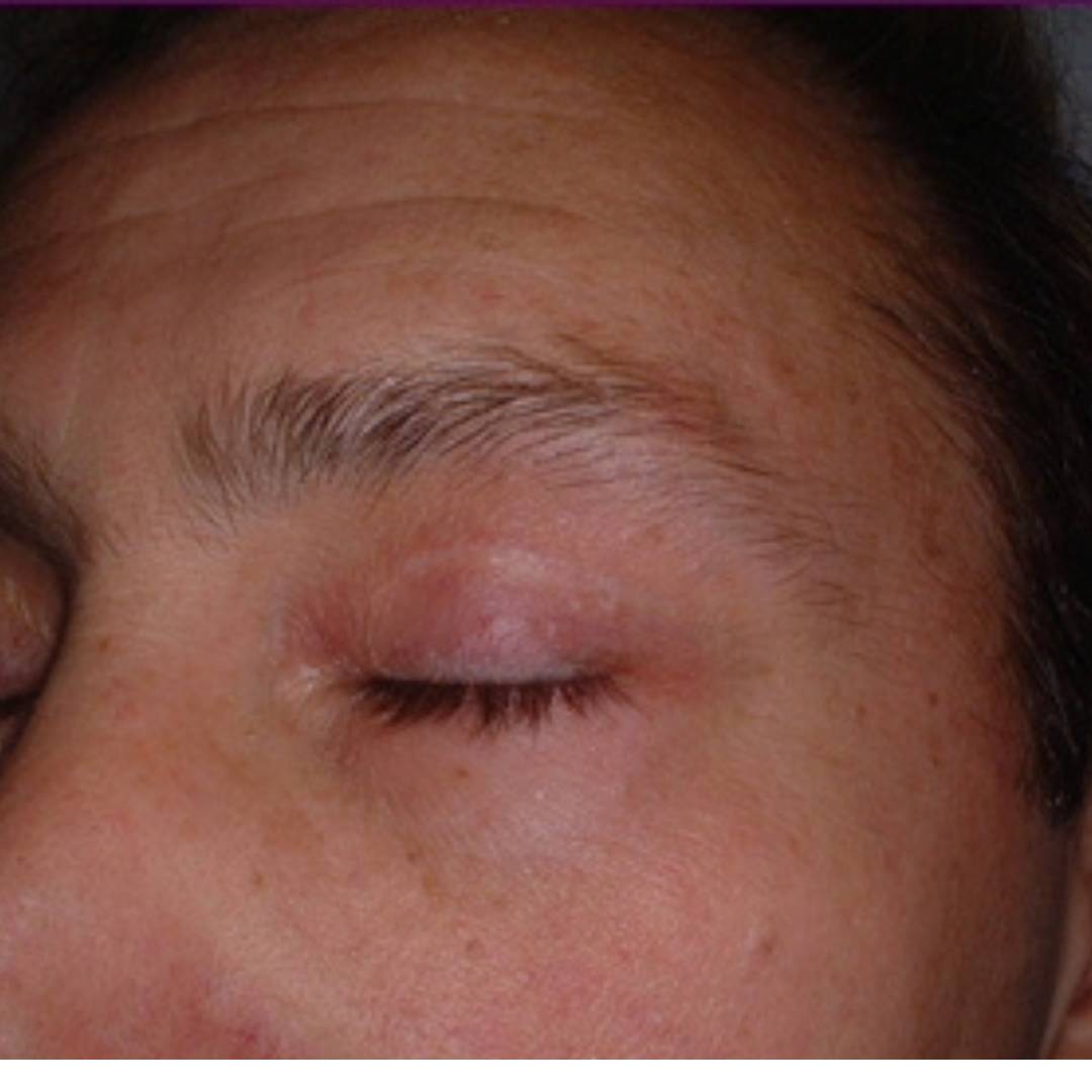 Blépharoplastie Chirurgicale inférieure homme après CLEAGE