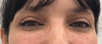 Blépharoplastie après CLEAGE