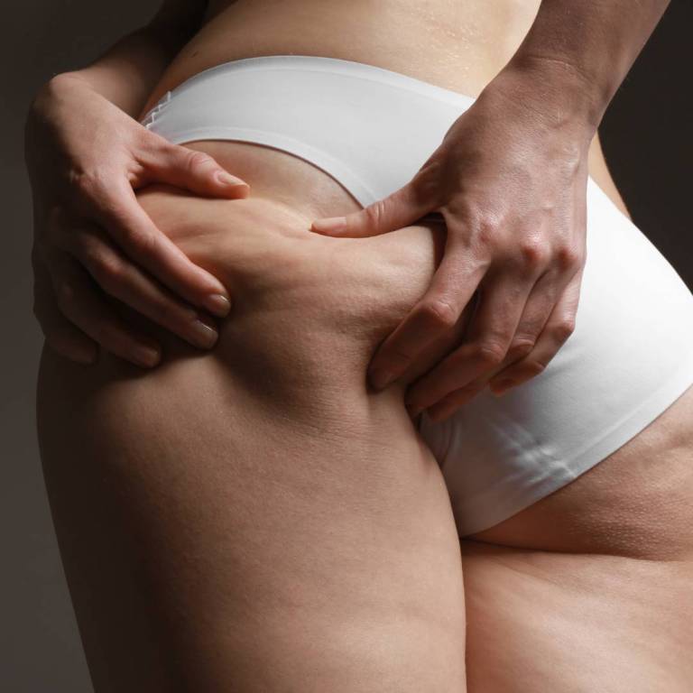 Traitement de la cellulites des fesses Clinique CLEAGE