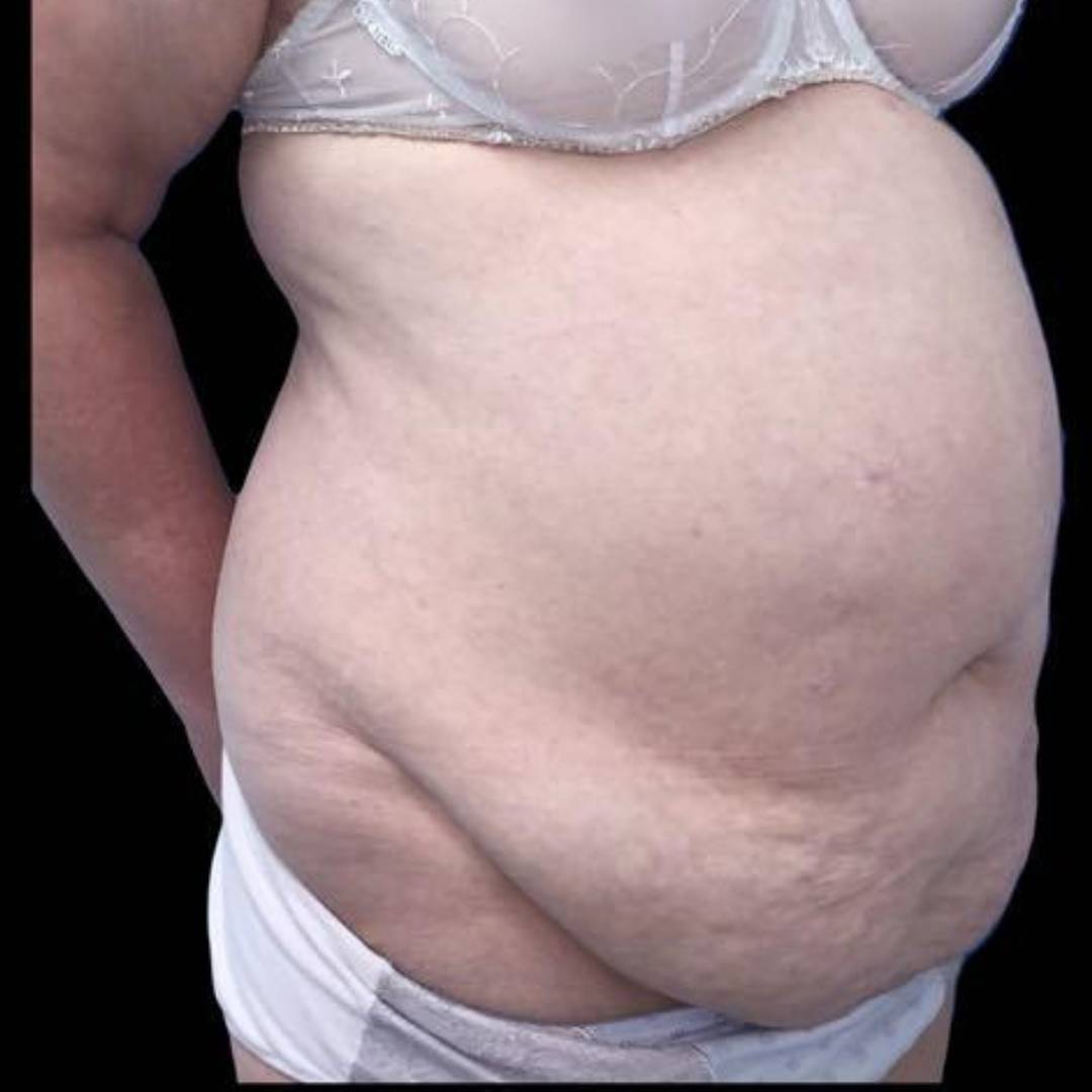 Patiente avant un abdominoplastie