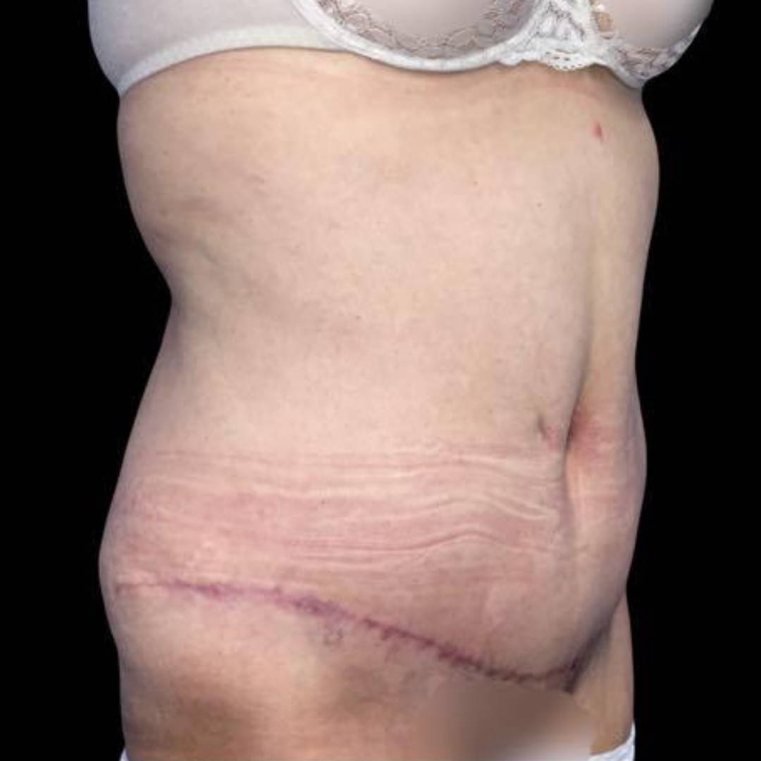 Résultat après un chirurgie de l'abdomen Clinique CLEAGE