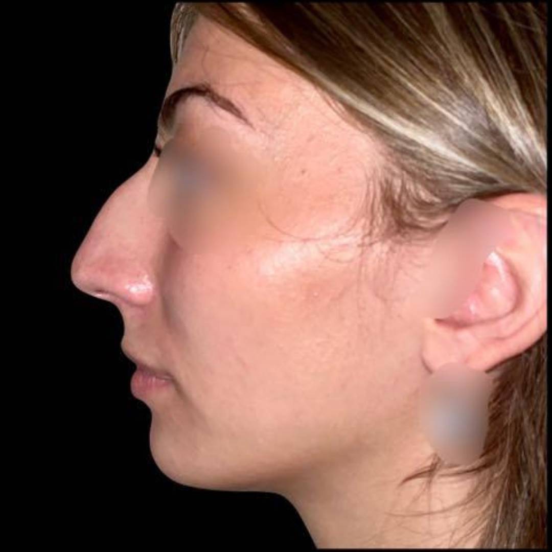Avant la chirurgie du nez