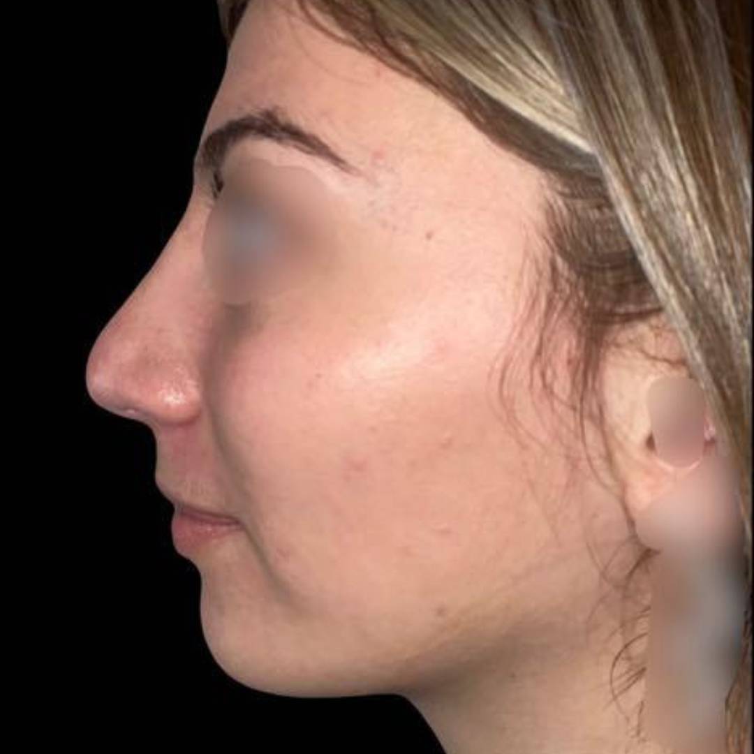 Après la chirurgie du nez clinique CLEAGE