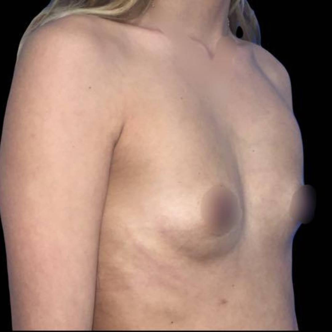 Avant une chirurgie mammaire chez cleage Geneve