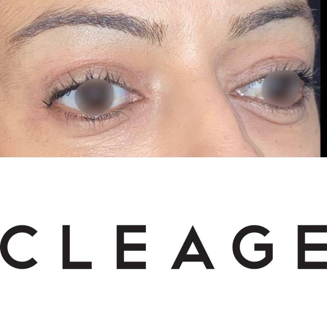 Après chirurgie des paupières Cleage