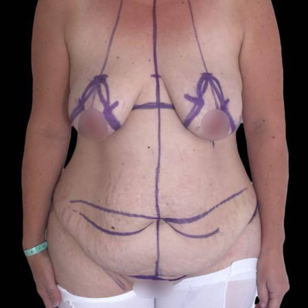 Avant Abdominoplastie a la clinique CLEAGE