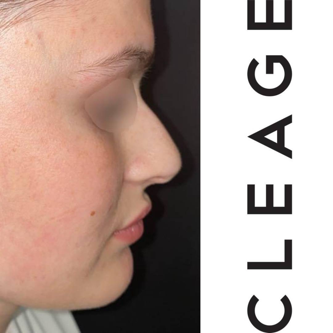 Rhinoplastie chirurgicale Clinique Cleage