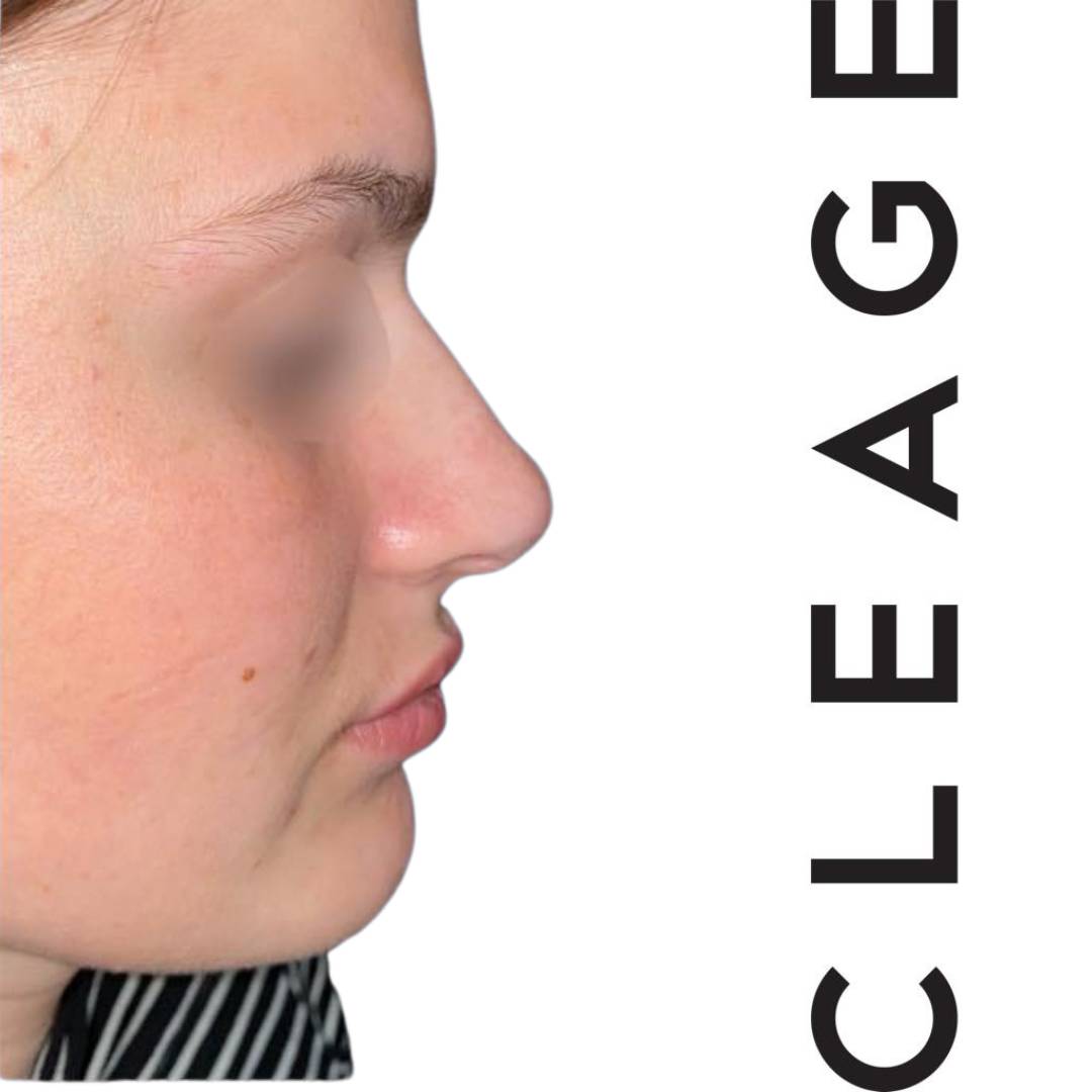 Chirurgie du nez par la clinique CLEAGE