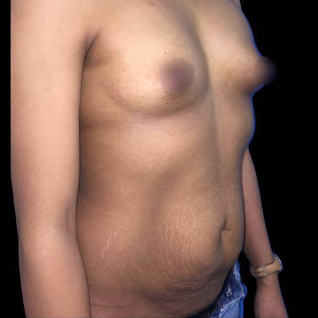 Abdominoplastie et prothèses mammaires chirurgicale CLEAGE