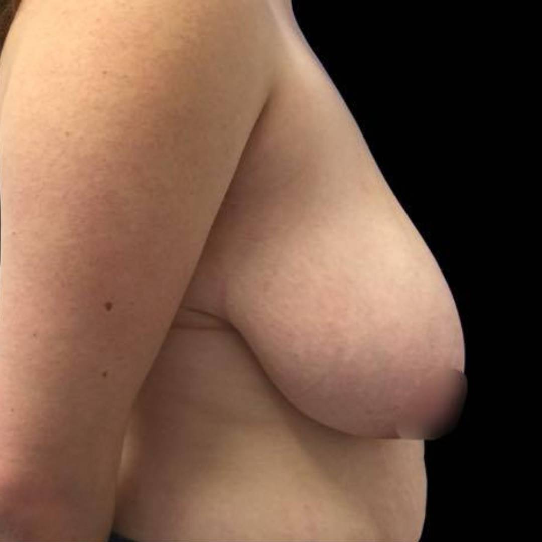 La pose mammaire est un problème récurent que nous traitons a la clinique CLEAGE