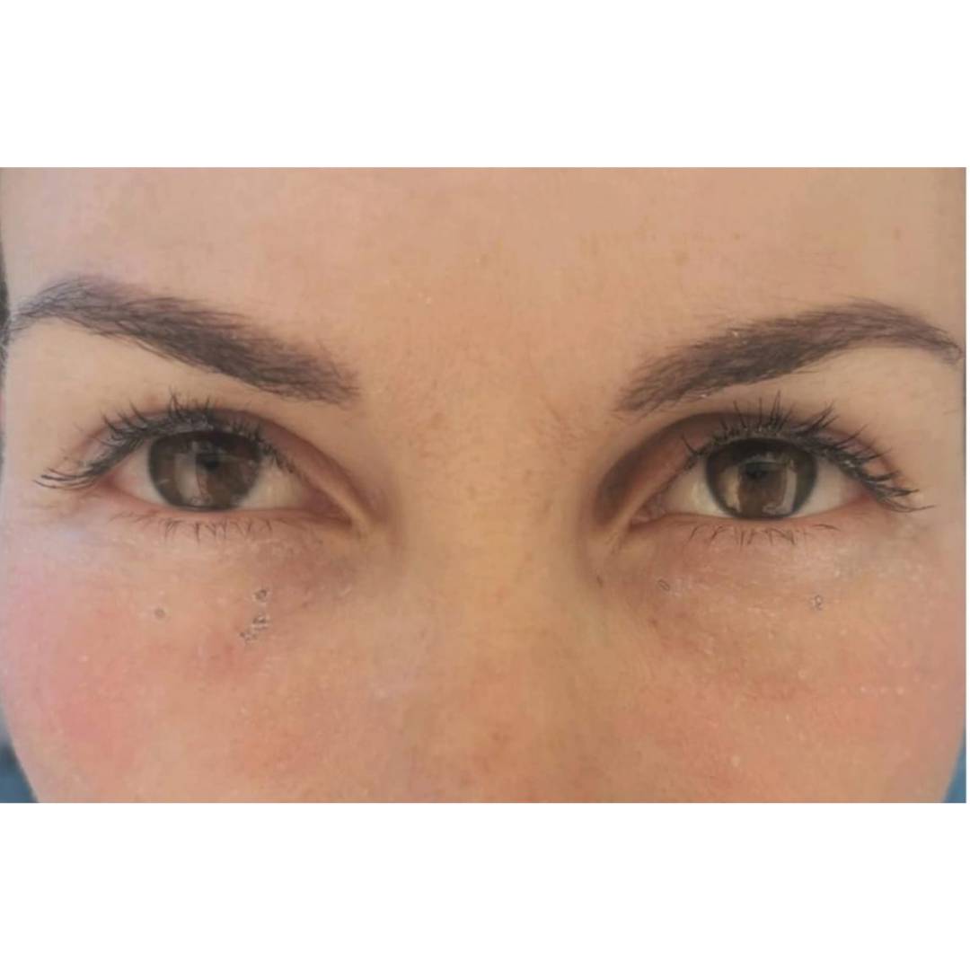 Patiente après la blépharoplastie inférieure par laser CO2 a la clinique CLEAGE Genève