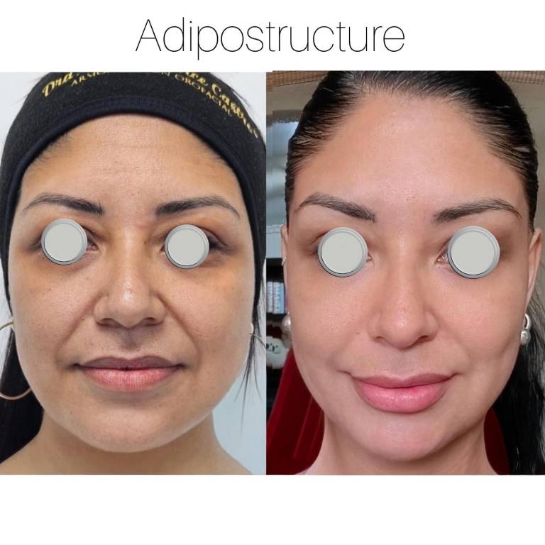 Adipostructure des lèvres