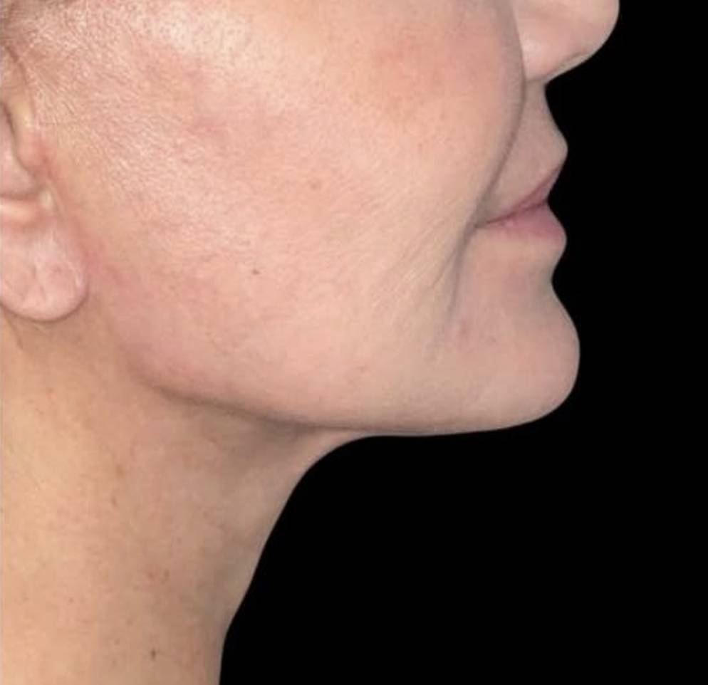 lifting cervico-facial après