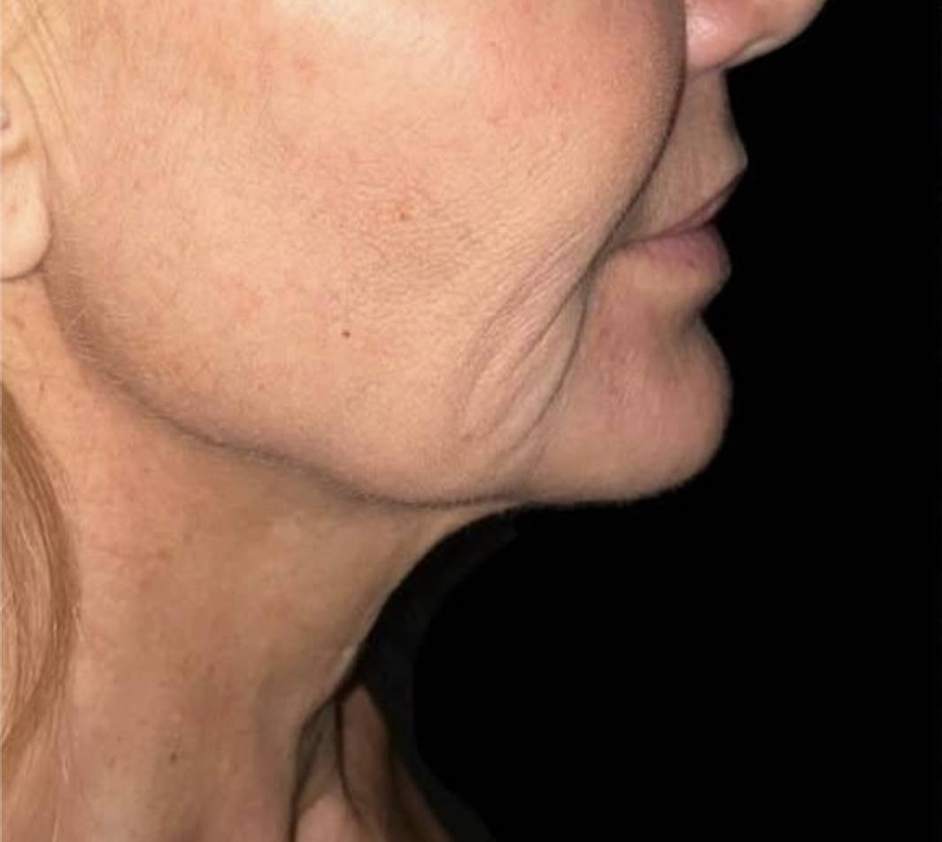 Lifting cervico-facial avant
