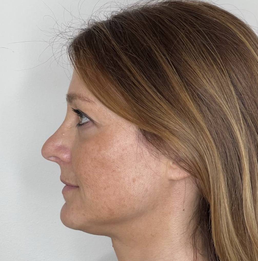 Lifting de côté après