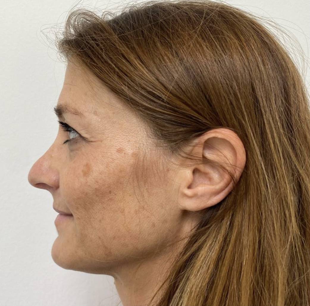 Lifting de côté avant