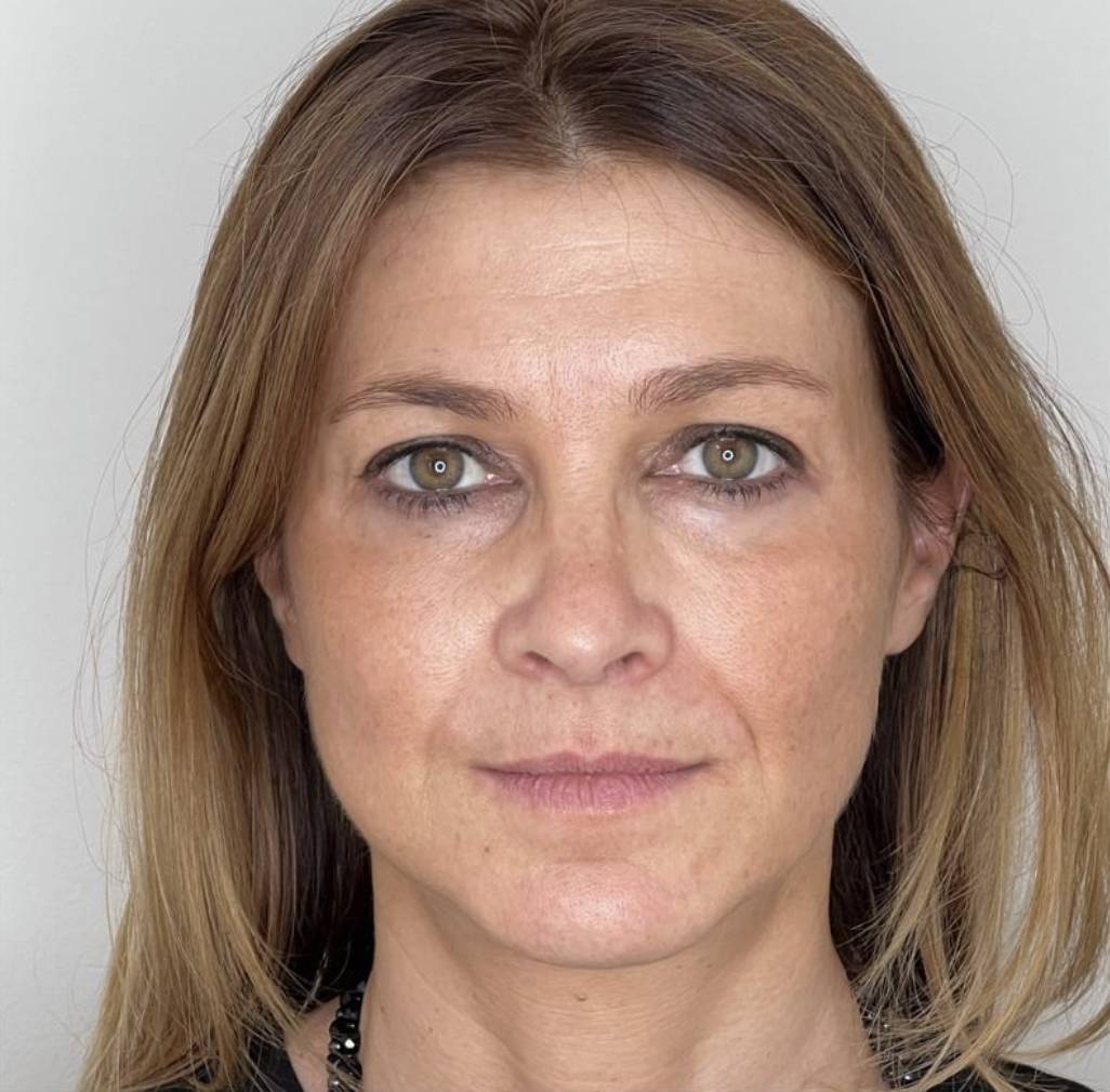 Lifting de face après