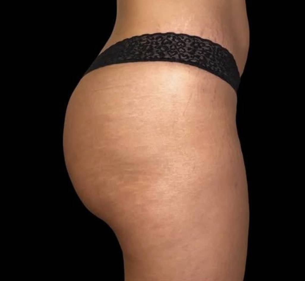Lipofilling des fesses après