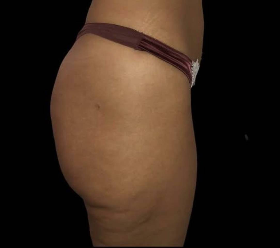 Lipofilling des fesses avant
