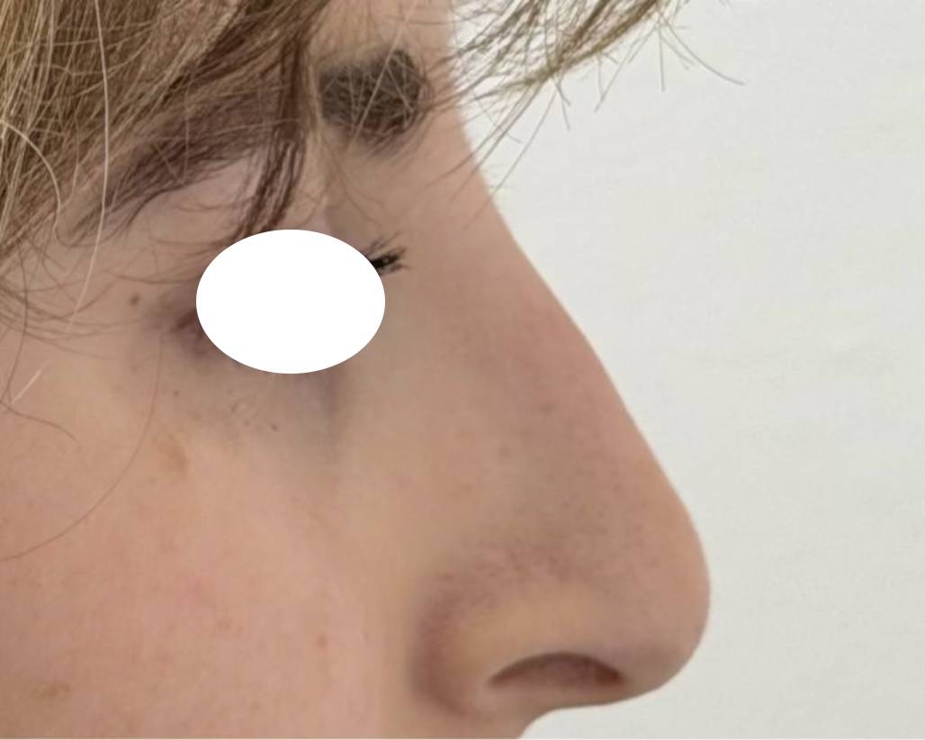 Rhino médicale après 3